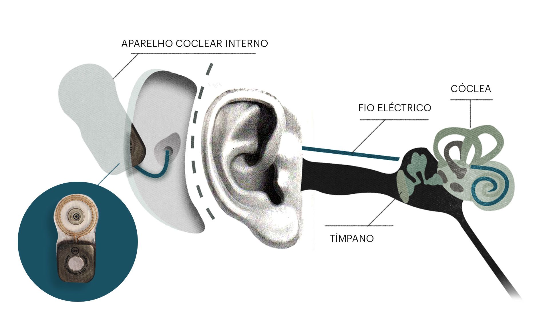 Parte interna e externa do implante